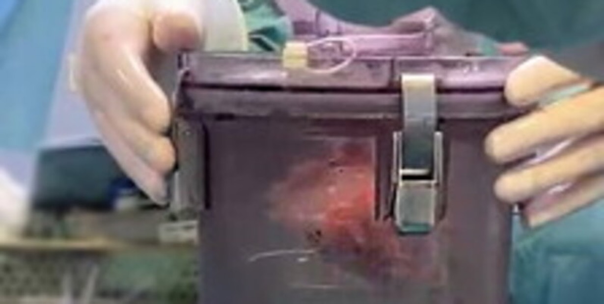 Sequestrato a Napoli il box di trasporto del cuore trapiantato a un bimbo di due anni