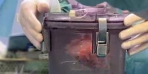 Organo trapianto bruciato: trasporto in un box di plastica a Napoli indaga la magistratura